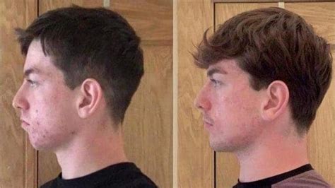 Does Mewing Actually Work for Adults? [ANSWERED] 