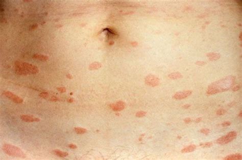 Tiny Red Blood Spots On Skin – Austra Health