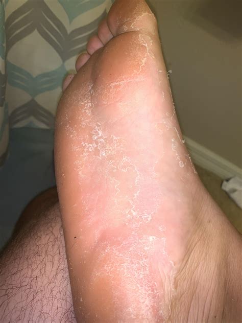 Why Is One Of My Feet So Dry at Angela Rich blog