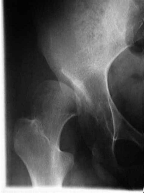 CE Angle of Wiberg : Wheeless' Textbook of Orthopaedics