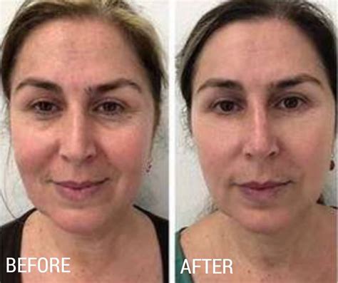Revitalize Your Radiance: Unveiling the Magic of Plasma Pen Treatment