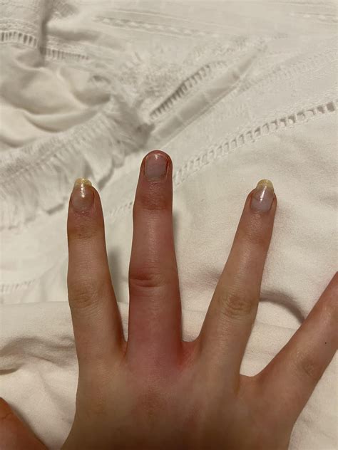 swollen red itchy finger - wtf help please : r/Dermatology