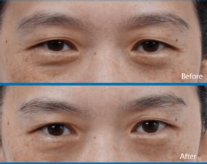 ultraformer mpt    eyes mico aes