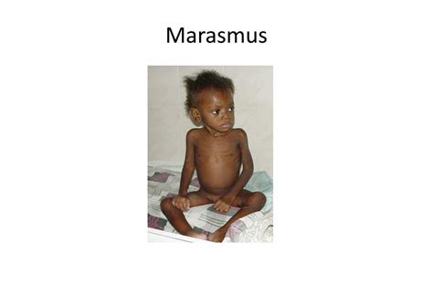 nutritional disorders powerpoint    id