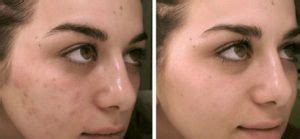 Exsynutriment Antes E Depois - Exsynutriment - Para Que Serve, Como Funciona e Efeitos Colaterais ...