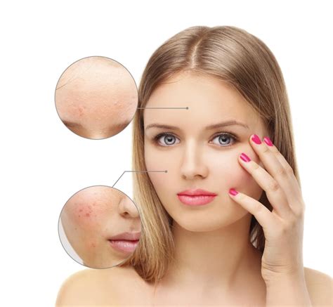Premium Photo | Post acne marks treating acne scars