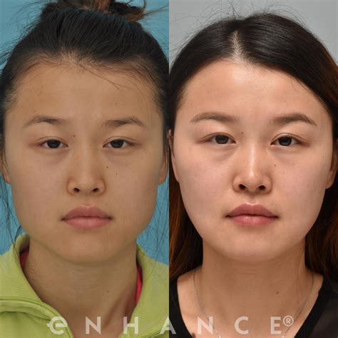 Korean Plastic Surgery Jaw Shaving
