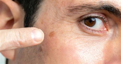 Light Brown Spots Appearing On Legs | Americanwarmoms.org