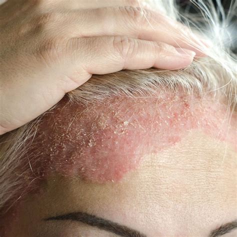 Psoriasis Scalp Treatment Natural