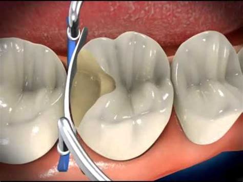 obturaciones youtube