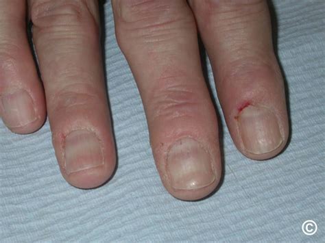 chronische paronychia paronychia symptoms   treatment