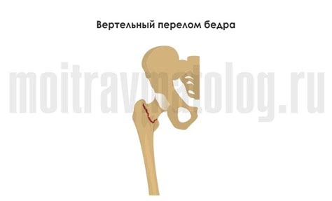 Вертельный перелом бедра (бедренной кости): симптомы, признаки, лечение ...