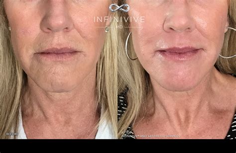 stem cell serum  infinivive md jack zamora md cosmetic surgery