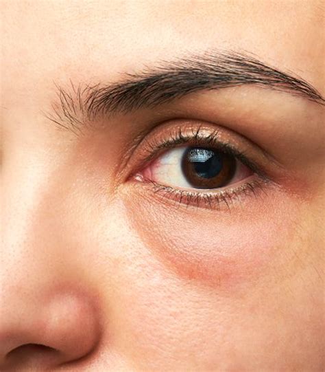 tear trough treatments london harley street dermal