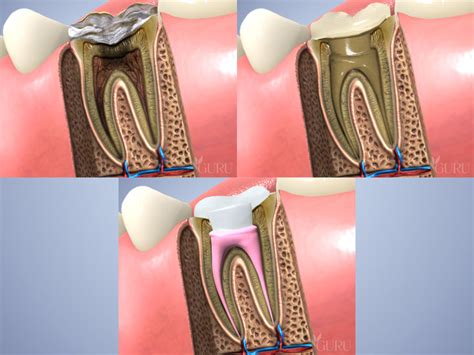 Dangers of a Damaged Tooth - Sedation and Implant Dentistry of ...