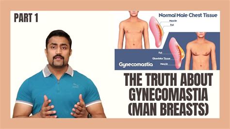 gynecomastia man breasts part  youtube