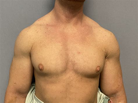 Plastic Surgery Case Study - Shoulder Widening By Clavicle Lengthening ...
