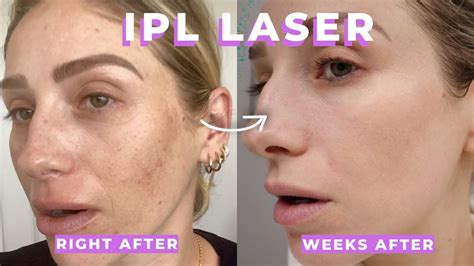 IPL + CLEAR AND BRILLIANT LASER REVIEW | What are they? Are they ...