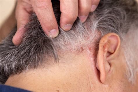 Scalp Psoriasis: Causes, Symptoms, and Treatment – Noophoric