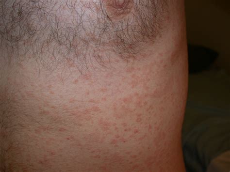 Christmas Tree Rash In Pityriasis Rosea at Mike Lyles blog