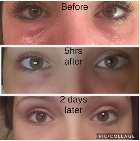 PRP / PRF Under Eye Treatment: Here's What You Should Know - Beverly ...