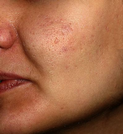 Inflamação Da Pele Do Rosto - Foto de Inflamação Da Pele Do Rosto De Espinhas E Acne Correção Para As ...