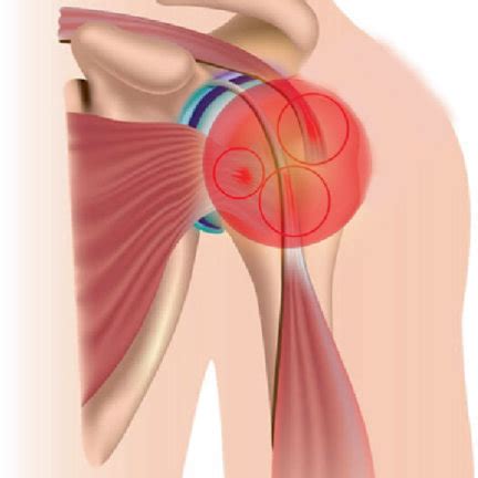 Major tendon injuries: (a) tendonitis, inflammation and irritation of... | Download Scientific ...