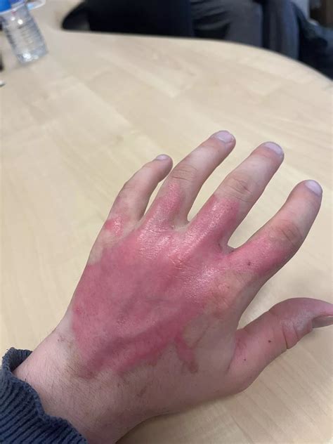 'UK's most dangerous plant' leaves teen in 'absolute hell' unable to