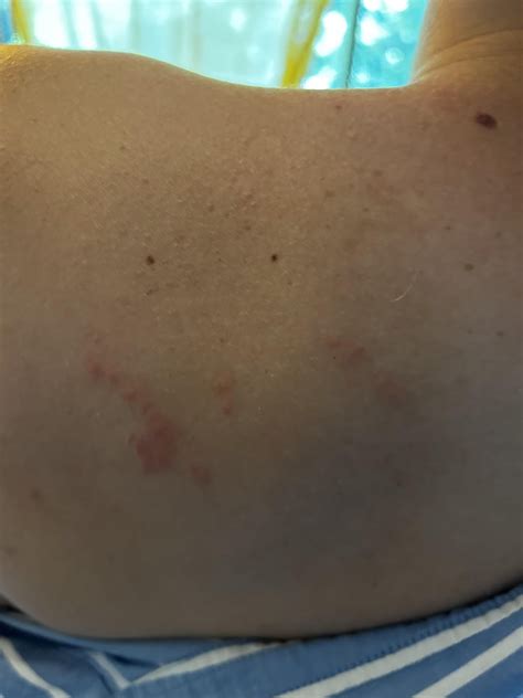 Rash or bug bites? : r/DermatologyQuestions
