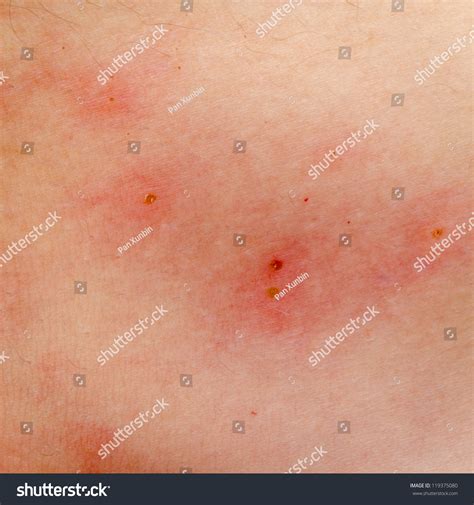 Eczema Allergy Rash Treatment at Marilyn Hudgins blog
