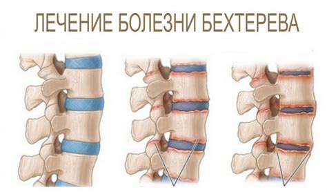 Лечение болезни Бехтерева в санатории Танжер-Крым
