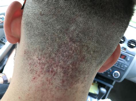 Back Of Neck Acne