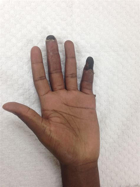 Frostbite Finger