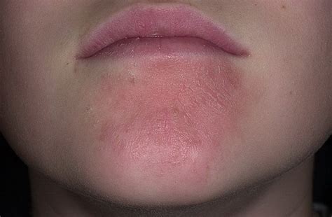 How to get rid of eczema. Eνerything you should know for successful curing
