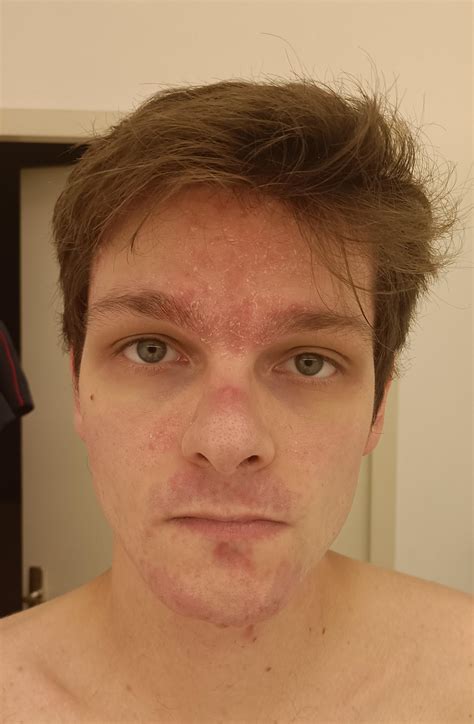 Anyone else with facial psoriasis? How bad is it ? I can't find decent