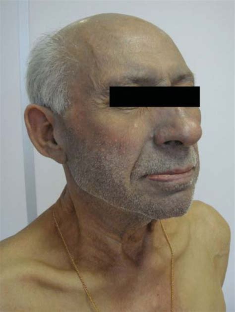 Hemochromatosis Skin Discoloration