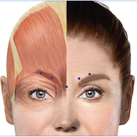 OnabotulinumtoxinA injection sites. This figure was modified from ...