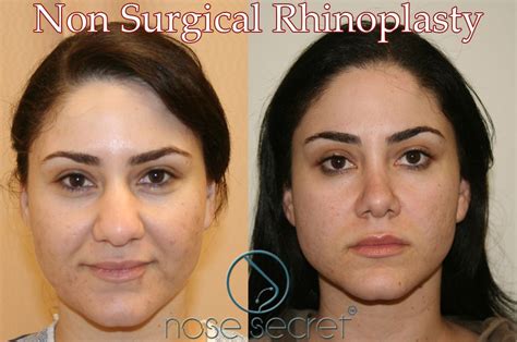nose job         sandra santos blog
