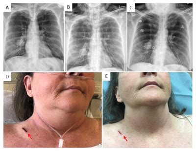 Subcutaneous Emphysema