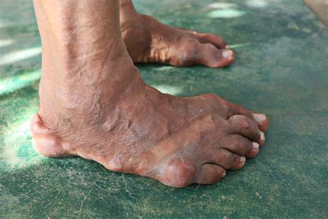 step  step diagnosing  managing septic arthritis