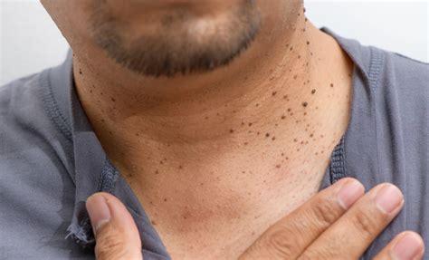 Skin Tags Treatment Options: What is Skin Tags Treatment? - Forefront ...