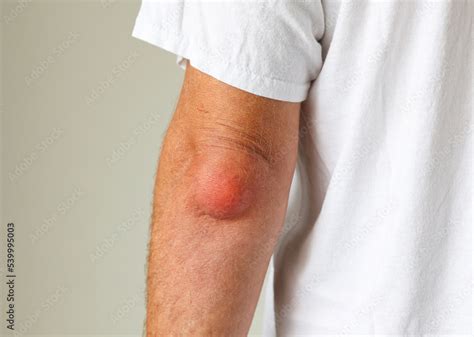 swollen fluid filled lump  elbow  ethan sines blog