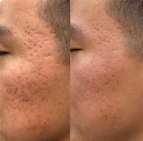 Tratamento Com Plasma No Rosto Valor - Tratamento com Plasma no rosto: Antes e depois – Antes da Fama