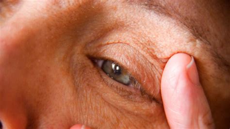 Itchy Eyes: Possible Causes and Treatments