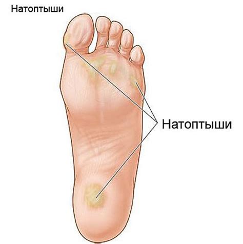 Эффективное лечение натоптышей со стержнем на ногах