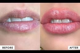 pink lips laser treatment  dubai abu dhabi sharjah price cost