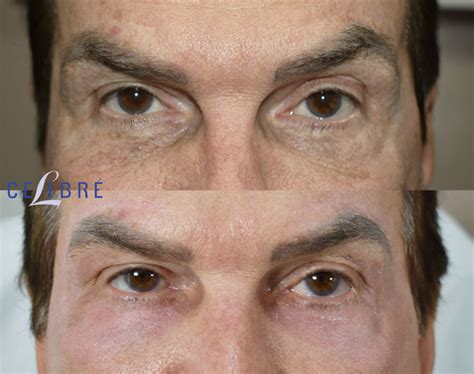 laser  wrinkles view laser skin rejuvenation
