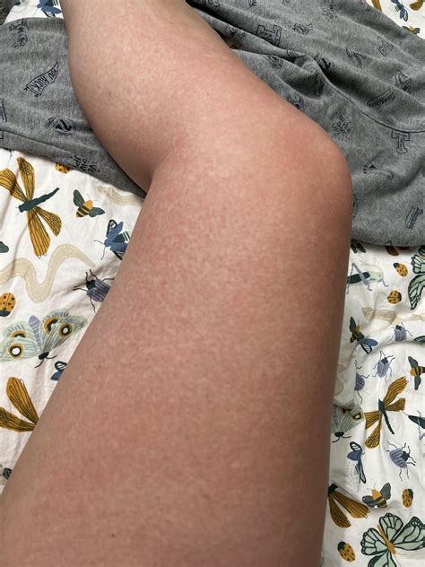 Never Had Sun Rash Before : r/DermatologyQuestions