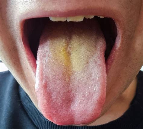 tongue colour    health  ai diagnoses correct