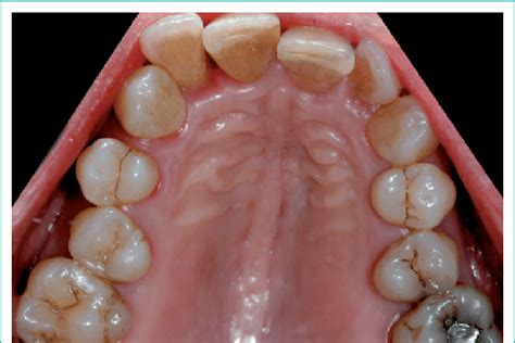 occlusal view   upper arch   scientific diagram